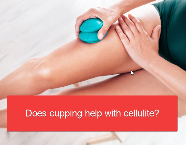 Does cupping help with cellulite?
